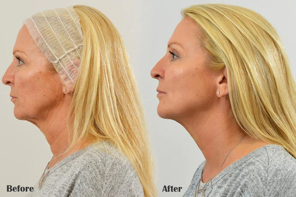 Face Filler Absorbable Collagen Protein Thread Face Lift Plump Silk Fibroin Line Carving Anti Aging Essence NoirKiss