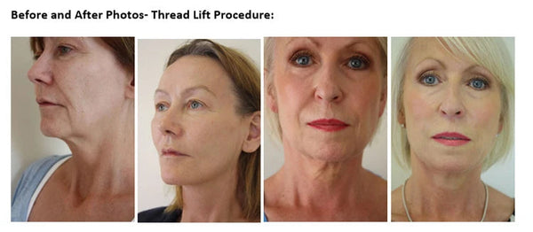 Face Filler Absorbable Collagen Protein Thread Face Lift Plump Silk Fibroin Line Carving Anti Aging Essence NoirKiss